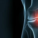 Modello anatomico dettagliato che mostra la muscolatura della coscia e del ginocchio accanto a una radiografia che evidenzia l'osteoartrosi, focus nitido sulla cartilagine e sull'osso, illuminazione da studio controllata, obiettivo macro 100mm, alta definizione, profondità di campo.