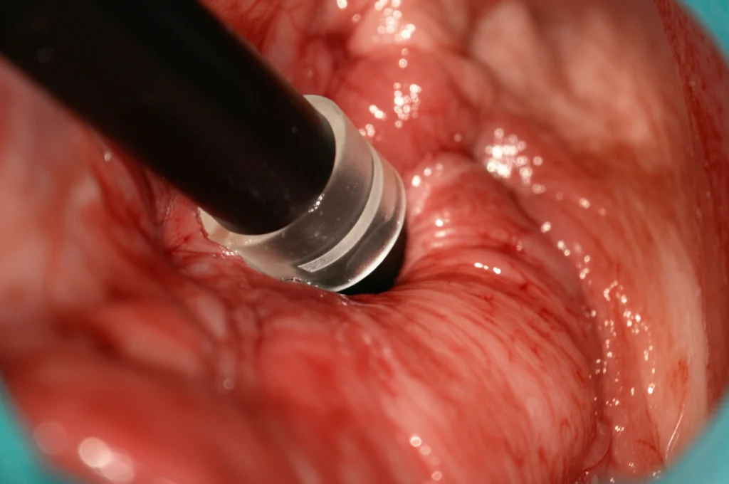 Fotografia d'azione durante una procedura di dissezione sottomucosa endoscopica (ESD) nello stomaco di un maiale. Si vede la punta dell'endoscopio con un cappuccio trasparente (idrogel) in azione vicino al tessuto. Teleobiettivo zoom 150mm, alta velocità dell'otturatore, tracciamento del movimento dello strumento endoscopico, illuminazione endoscopica.
