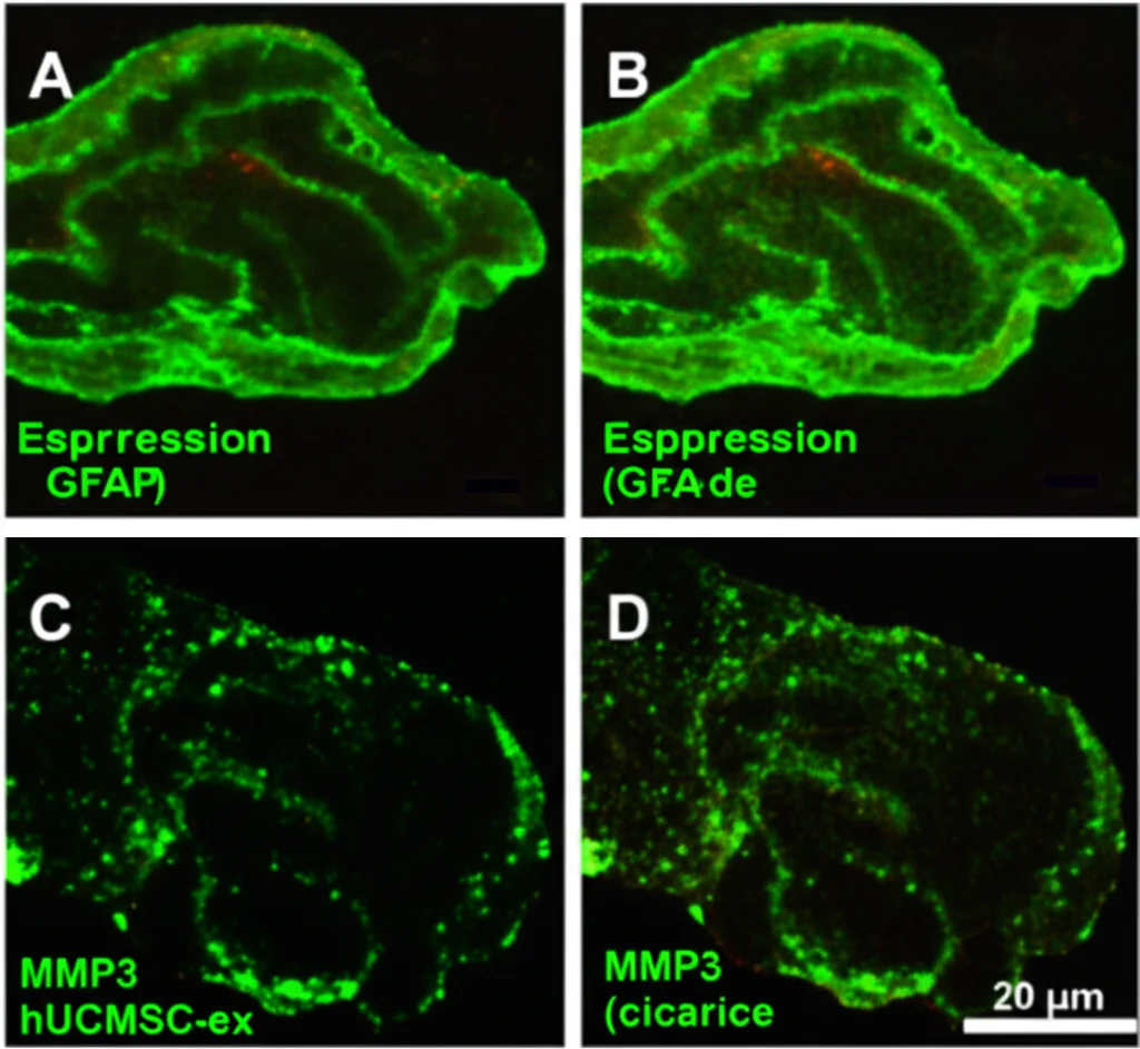 Immagine di immunofluorescenza di sezioni di cervello di ratto. A sinistra, un cervello post-ICH controllo mostra alta espressione di GFAP (verde, astrociti reattivi) e MMP3 (rosso, cicatrice). A destra, un cervello trattato con hUCMSC-ex mostra espressione ridotta di entrambi. Laser confocal microscope, obiettivo 20x, colori fluorescenti brillanti, confronto side-by-side chiaro.