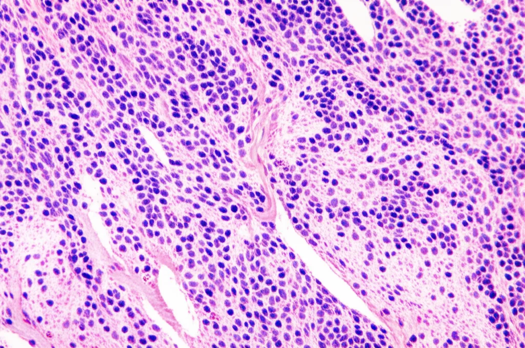 Fotografia macro, obiettivo 80mm, di vetrini da istopatologia con sezioni di tessuto tumorale colorate per immunochimica (IHC) sotto la luce di un microscopio da laboratorio, alta definizione, messa a fuoco precisa, illuminazione controllata, che mostra cellule positive per INSM1.