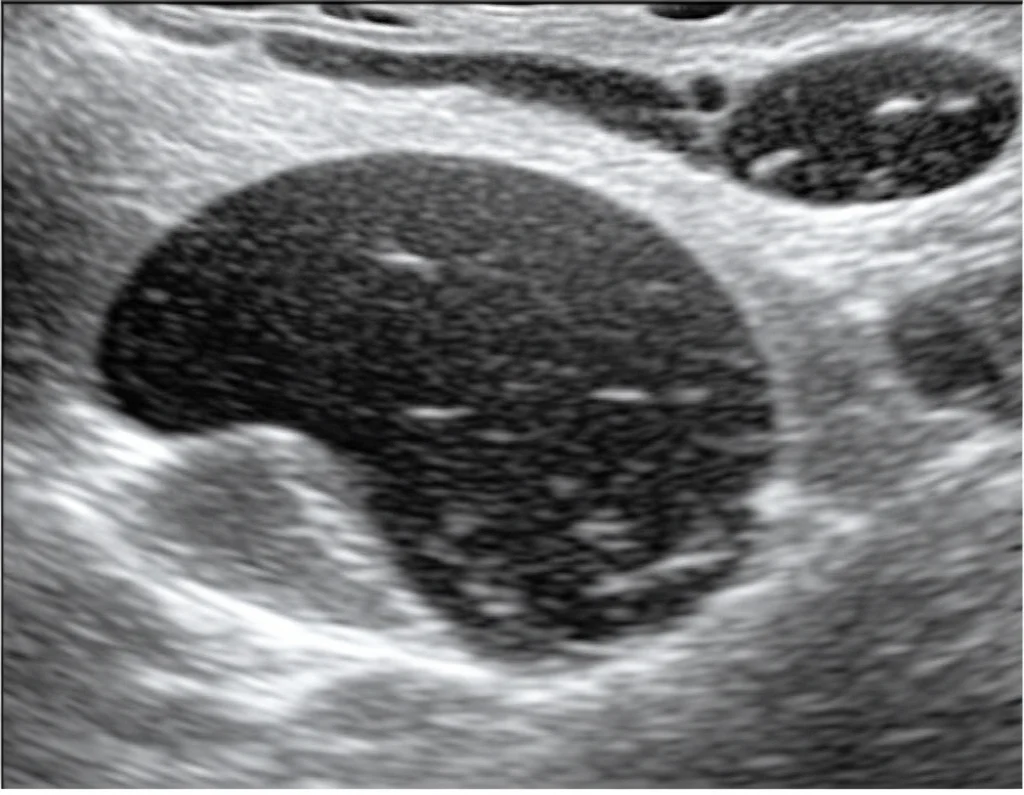 Immagine ecografica HFR CEUS di un linfonodo superficiale, visualizzazione dettagliata del flusso sanguigno con mezzo di contrasto, alta risoluzione temporale, prime fasi arteriose, stile medico-scientifico, illuminazione controllata, messa a fuoco precisa, obiettivo macro 90mm.