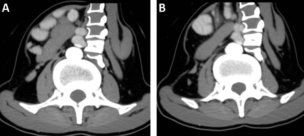 Immagine comparativa TAC, macro lens 100mm, high detail, precise focusing, controlled lighting, che mostra sezioni trasversali dell'addome a livello L3 e del torace a livello T11. Una sezione mostra un indice muscolare scheletrico (SMI) e una densità minerale ossea (BMD) normali, mentre l'altra mostra chiaramente sarcopenia (muscoli ridotti) e osteopenia (osso meno denso), rappresentando l'osteosarcopenia.