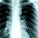 Immagine medica di polmoni affetti da osteosarcoma metastatico, con un focus sulla distinzione tra noduli polmonari centrali, vicini alle strutture bronchiali e vascolari principali, e noduli periferici. Macro lens, 100mm, high detail, illuminazione controllata per evidenziare le diverse localizzazioni e la loro implicazione prognostica.