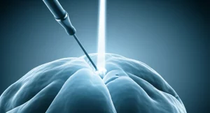 Visualizzazione 3D stilizzata ma fotorealistica di un endoscopio che naviga delicatamente attraverso il tessuto cerebrale verso un ematoma, guidato da un fascio di luce virtuale (simbolo della guida ecografica/neuronavigazione), obiettivo 50mm, atmosfera high-tech, colori blu e grigio duotone.
