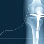 Immagine concettuale che mostra un grafico astratto con una linea in netta salita sovrapposto a una radiografia stilizzata di un'anca con protesi, simboleggiando il miglioramento della funzione e del benessere post-intervento, stile duotone blu e grigio per un look moderno e medico, obiettivo 50mm.