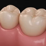 Primo piano, obiettivo macro 70mm, focalizzato su una corona dentale in resina stampata 3D color dente, perfettamente adattata su un modello di molare primario di un bambino. Luce soffusa e naturale che enfatizza l'integrazione estetica e l'adattamento preciso al margine. Alto dettaglio, profondità di campo ridotta.