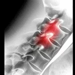 Immagine fotorealistica di una sezione della colonna vertebrale umana che mostra chiaramente un'area di infiammazione e infezione tipica dell'osteomielite vertebrale. La foto è scattata con un obiettivo macro da 100mm per un'elevata definizione dei dettagli, con illuminazione da studio controllata per enfatizzare la gravità della condizione medica.