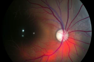 Primo piano di un occhio umano sottoposto a esame OCTA, con le strutture vascolari della retina evidenziate in rosso e blu su sfondo scuro, illuminazione da studio per massimizzare i dettagli, lente macro 100mm, per simboleggiare l'indagine sulla salute oculare in ambienti lavorativi difficili come le miniere di ferro.