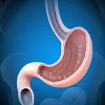 Illustrazione medica dettagliata che mostra l'anatomia dello stomaco e dell'intestino prima e dopo un intervento di SADI-S, evidenziando la sleeve gastrica e il bypass duodeno-ileale. L'immagine è realizzata con tecnica macro, focale 100mm, con alta definizione dei dettagli e illuminazione controllata per un aspetto professionale e didattico.