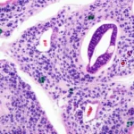 Immagine concettuale di un vetrino da microscopio con cellule tumorali mammarie e prostatiche affiancate, evidenziando i marcatori NKX3.1 e P501S con colori distinti. Illuminazione da laboratorio, focus selettivo, macro lens, 85mm, high detail, per illustrare la sfida diagnostica tra carcinoma mammario maschile e metastasi prostatica.