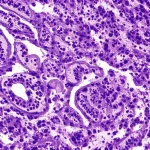 Immagine macro ad alta definizione di cellule tumorali dell'adenocarcinoma gastrico del cardias, illuminate con precisione, obiettivo macro 100mm, che evidenzia la complessità della malattia e la sfida chirurgica.