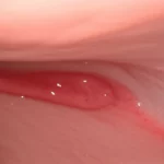 Primo piano di un esofago con segni di esofagite eosinofila, visualizzato tramite endoscopia, obiettivo macro 90mm, alta definizione dei dettagli dell'infiammazione, illuminazione clinica precisa. Simboleggia la natura fisica e l'impatto della malattia.