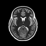 Brain MRI scan showing basal ganglia, 100mm Macro lens, High detail, precise focusing, controlled lighting, medical diagnostic context