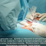 Primo piano di un ginocchio durante un intervento di artroplastica totale, il campo operatorio è esangue e ben visibile, mettendo in risalto le strutture anatomiche e gli impianti protesici. Luce chirurgica intensa focalizzata sull'area. Obiettivo macro 100mm, alta definizione, illuminazione controllata, focus preciso.