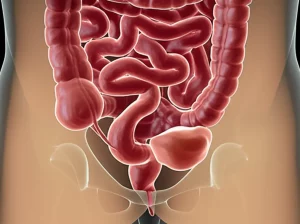 Visualizzazione 3D di un tumore rettale che si estende fino a coinvolgere la riflessione peritoneale, con il peritoneo evidenziato. Immagine medica ad alta risoluzione, obiettivo prime 35mm, resa fotorealistica con profondità di campo per enfatizzare l'area di invasione.