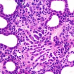 Immagine al microscopio ad alta risoluzione di cellule di carcinoma esofageo squamoso, macro lens 80mm, high detail, precise focusing, con illuminazione controllata per evidenziare le strutture cellulari e le alterazioni genomiche.