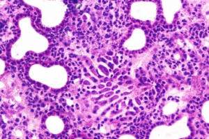Immagine al microscopio ad alta risoluzione di cellule di carcinoma esofageo squamoso, macro lens 80mm, high detail, precise focusing, con illuminazione controllata per evidenziare le strutture cellulari e le alterazioni genomiche.