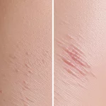 Immagine composita che mostra a sinistra pelle con lesioni psoriasiche evidenti e a destra la stessa area di pelle quasi completamente guarita dopo trattamento biologico. Luce laterale morbida, obiettivo prime 35mm, focus nitido sulla texture della pelle.