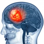 Visualizzazione 3D fotorealistica di un cervello umano con un tumore evidenziato nel lobo occipitale, con particolare attenzione ai vasi sanguigni circostanti e un'area di ostruzione venosa. Prime lens, 35mm, depth of field, illuminazione drammatica per enfatizzare l'area interessata e la complessità della condizione.
