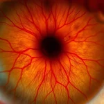 Immagine macro altamente dettagliata della retina di un occhio affetto da edema maculare diabetico, con focus sui vasi sanguigni e sull'accumulo di liquidi, illuminazione da studio per massima chiarezza, lente macro 90mm.