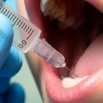 Primo piano di un dentista che applica un gel contenente nanoparticelle di melatonina in una tasca parodontale usando una siringa con punta smussa. Obiettivo macro 80mm, focus preciso sulla punta della siringa e sul tessuto gengivale, illuminazione clinica controllata, alta definizione.