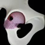 Immagine macro, obiettivo 90mm, di un modello anatomico di articolazione dell'anca umana che mostra una frattura dell'acetabolo con placche e viti di fissaggio interne visibili. Illuminazione controllata da studio per evidenziare i dettagli della frattura e dell'hardware chirurgico, alta definizione, messa a fuoco precisa sulla superficie articolare.