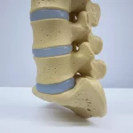 Modello anatomico dettagliato della colonna vertebrale lombare che mostra chiaramente un'ernia del disco tra due vertebre, illuminazione da studio controllata e precisa, lente macro 100mm per massima definizione dei dettagli, sfondo neutro e pulito.