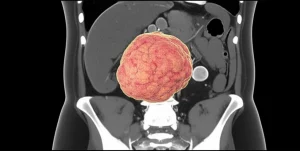 Visualizzazione 3D fotorealistica di un angiomixoma aggressivo che si estende dalla regione pelvica all'addome in un paziente maschile, evidenziando l'infiltrazione dei tessuti e la compressione degli organi adiacenti, prime lens 35mm, illuminazione drammatica per sottolineare la natura invasiva del tumore, con dettagli anatomici precisi.