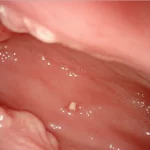 Immagine endoscopica dettagliata che mostra una mucosa gastrica infiammata e atrofica, con aree di fragilità e aderenze biancastre, illuminazione controllata per evidenziare la texture, obiettivo macro 90mm, alta definizione.