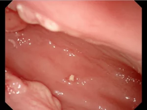 Immagine endoscopica dettagliata che mostra una mucosa gastrica infiammata e atrofica, con aree di fragilità e aderenze biancastre, illuminazione controllata per evidenziare la texture, obiettivo macro 90mm, alta definizione.