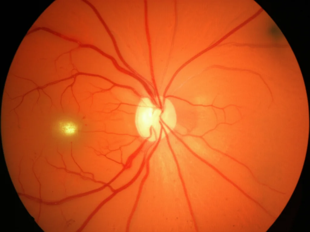 Immagine macro altamente dettagliata di una retina affetta da retinopatia diabetica proliferante, con neovasi e aree di emorragia vitreale. Illuminazione da studio per enfatizzare la tridimensionalità dei vasi. Lente macro, 100mm, messa a fuoco precisa, luce controllata.
