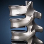 Immagine macro di una vite peduncolare spinale in titanio posizionata chirurgicamente su un modello anatomico dettagliato di vertebra toracolombare umana, illuminazione chirurgica controllata che evidenzia la texture metallica e ossea, alta definizione, obiettivo macro 100mm, sfondo leggermente sfocato.