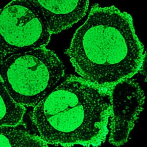 Vista microscopica, obiettivo macro 100mm, di cellule di carcinoma esofageo con proteine MCM8 evidenziate in verde brillante, che mostrano attiva angiogenesi con formazione di nuovi vasi sanguigni in rosso, alta definizione, illuminazione controllata, duotone verde e rosso per enfatizzare i processi biologici.