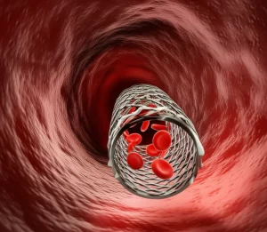 Immagine fotorealistica ad alto dettaglio di uno stent vascolare metallico espanso all'interno di un'arteria carotide stilizzata, con globuli rossi che fluiscono liberamente attraverso di esso, simboleggiando il successo della procedura endovascolare. Illuminazione drammatica che enfatizza la struttura dello stent e il flusso sanguigno ripristinato dopo la rimozione dell'occlusione. Obiettivo macro 100mm, messa a fuoco precisa sullo stent e sul flusso.