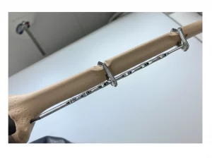 Immagine dettagliata di un chiodo intramidollare inserito in un modello di omero, con focus sulle viti di bloccaggio distali. Obiettivo macro 100mm, alta definizione, illuminazione da studio per enfatizzare la precisione chirurgica e i dettagli metallici del chiodo e delle viti contro la struttura ossea sintetica.