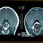 Primo piano di un'immagine di risonanza magnetica (RM) su uno schermo, divisa a metà: una parte mostra artefatti da movimento evidenti (sfocature, ghosting), l'altra parte mostra la stessa immagine corretta e nitida grazie all'intelligenza artificiale. Illuminazione drammatica che evidenzia il contrasto tra le due metà, obiettivo macro 100mm, alta definizione dei dettagli dell'immagine.