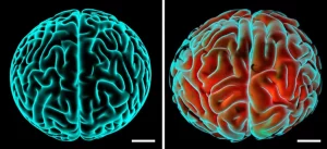 Immagine concettuale fotorealistica che mostra affiancati un organoide cerebrale di controllo con struttura complessa e un organoide cerebrale mutato (lissencefalia) più liscio e rigido, con una visualizzazione sovrapposta della matrice extracellulare disorganizzata nel mutante. Illuminazione da laboratorio drammatica, profondità di campo, obiettivo 50mm prime.