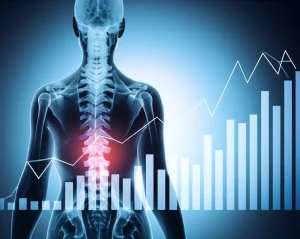 Immagine simbolica e fotorealistica: una sezione trasversale di una colonna vertebrale anziana con una vertebra evidenziata in rosso che mostra segni iniziali di collasso (come la malattia di Kummell), sovrapposta a un grafico astratto che indica fattori di rischio crescenti. Obiettivo prime, focale 50mm, profondità di campo che sfoca lo sfondo, illuminazione drammatica per enfatizzare la vertebra a rischio, toni freddi con accento rosso.