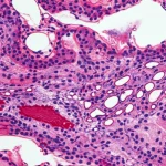 Macro lens, 100mm, high detail, precise focusing, controlled lighting: Microscopic view of kidney tubules showing damage and repair.