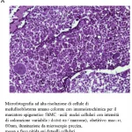 Microfotografia ad alta risoluzione di cellule di medulloblastoma umano colorate con immunoistochimica per il marcatore epigenetico 5hmC, visualizzando nuclei cellulari con intensità di colorazione variabile (marrone), obiettivo macro 60mm, illuminazione da microscopio precisa, messa a fuoco nitida sui dettagli cellulari.
