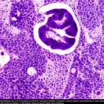 Visualizzazione artistica e dettagliata al microscopio di cellule di carcinoma insulare tiroideo, che mostra i caratteristici nidi (insulae) di cellule neoplastiche. Illuminazione da laboratorio che evidenzia la struttura cellulare e l'alta densità. Obiettivo macro 90mm, alta definizione.