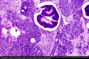 Visualizzazione artistica e dettagliata al microscopio di cellule di carcinoma insulare tiroideo, che mostra i caratteristici nidi (insulae) di cellule neoplastiche. Illuminazione da laboratorio che evidenzia la struttura cellulare e l'alta densità. Obiettivo macro 90mm, alta definizione.