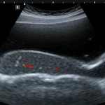 Close-up medical image showing a segmented thoracolumbar fascia within an ultrasound scan, highlighting different tissue layers. Macro lens, high detail, precise focusing, controlled lighting.