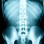 Immagine concettuale di un sistema di fissaggio spinale Waveflex applicato alla colonna lombare, con un chirurgo che osserva una radiografia in background. Lente prime 50mm, illuminazione da studio con leggero effetto drammatico, profondità di campo per mettere a fuoco l'impianto e sfocare leggermente il chirurgo.