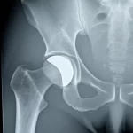 Immagine fotorealistica di una radiografia pelvica post-operatoria che mostra una protesi totale d'anca impiantata tramite approccio anteriore, con sovrapposizioni grafiche circolari che evidenziano gli angoli di antiversione e inclinazione del cotile acetabolare rispetto alla zona sicura di Lewinnek (rappresentata come un'area rettangolare semitrasparente). Dettagli nitidi dell'osso trabecolare e della superficie lucida della protesi, illuminazione uniforme tipica di un light box medico, obiettivo prime 50mm, profondità di campo sufficiente a mantenere a fuoco sia l'osso che la protesi.