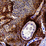 Visualizzazione scientifica avanzata che mostra una sezione di tessuto tumorale con dati di trascrittomica spaziale sovrapposti, evidenziando l'eterogeneità genetica (CNAs) con colori diversi. Focus nitido, illuminazione drammatica controllata, lente macro 85mm, alta risoluzione.