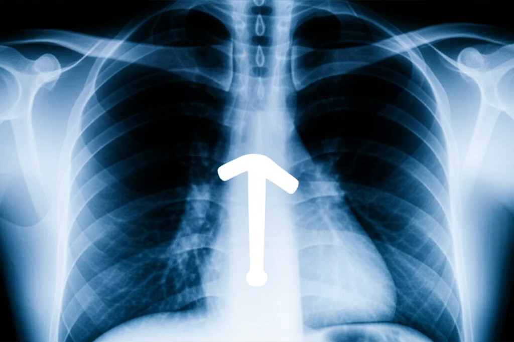 Fotografia concettuale che rappresenta un dilemma diagnostico medico: una radiografia del torace sfocata su cui è sovrapposto un punto interrogativo luminoso e definito, obiettivo 35mm, profondità di campo accentuata, toni blu e grigi duotone per un'atmosfera clinica e misteriosa.