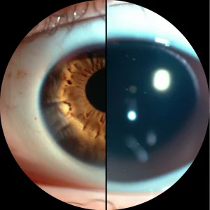 Immagine medica dettagliata che mostra un confronto fianco a fianco di un occhio dopo vitrectomia: metà con tamponamento a olio di silicone, metà con tamponamento a gas. Evidenziare le differenze strutturali sulla coroide. Obiettivo macro 85mm, illuminazione controllata da studio, alta definizione, focus preciso sulle strutture oculari interne.