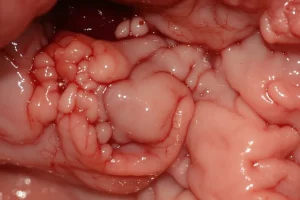 Immagine medica illustrativa di una cistifellea umana con una visibile perforazione, resa con tecnica fotorealistica, obiettivo macro 100mm per evidenziare i dettagli della lesione, illuminazione da studio per chiarezza diagnostica, sfondo neutro per concentrarsi sull'organo.