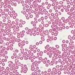 Rappresentazione microscopica ad alta definizione di cellule leucemiche nel midollo osseo, alcune evidenziate in rosso per mostrare la presenza della mutazione KIT. Illuminazione da laboratorio controllata, obiettivo macro 90mm, messa a fuoco precisa sui dettagli cellulari, sfondo leggermente sfocato.
